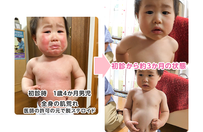 初診時　1歳4か月男児 全身の肌荒れ